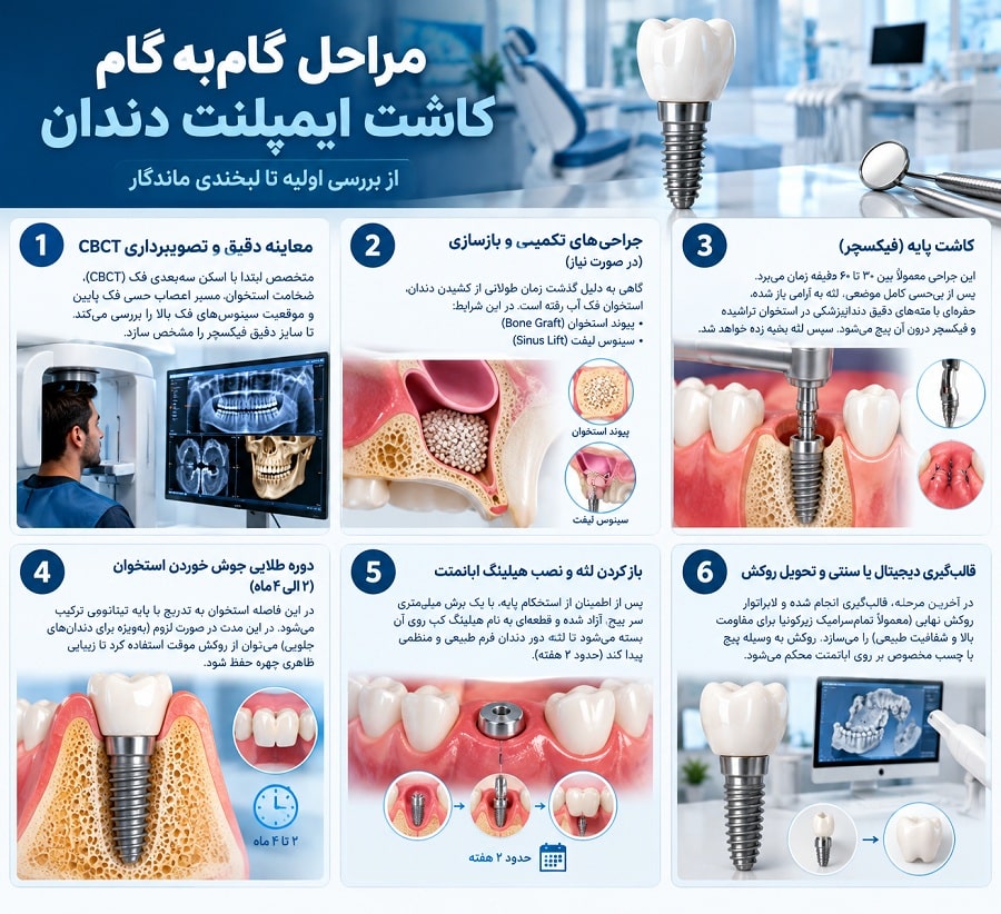 راهنمای 0 تا 100 ایمپلنت دندان