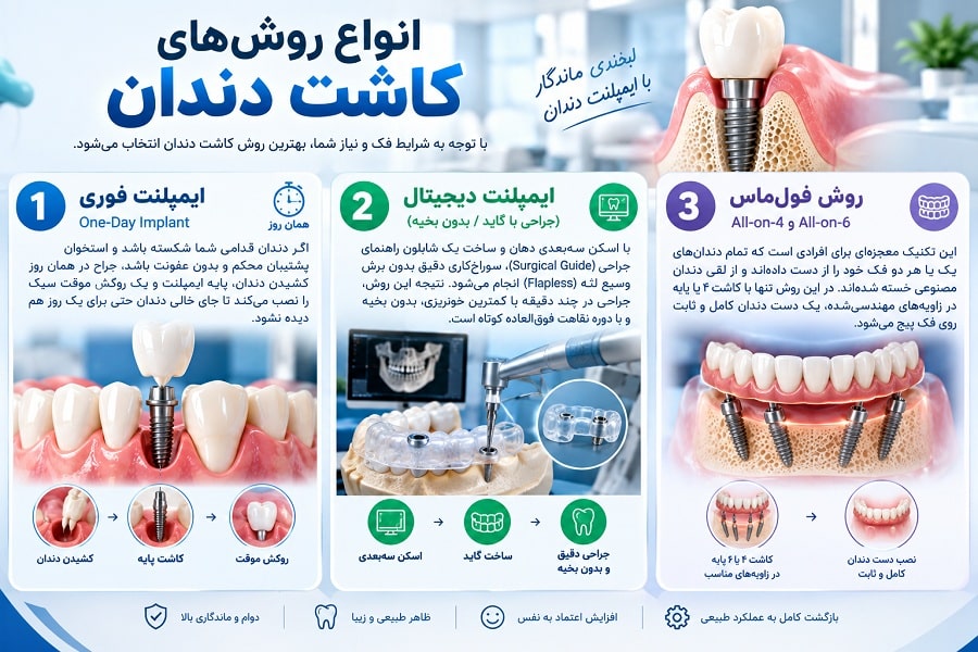 راهنمای 0 تا 100 ایمپلنت دندان-4
